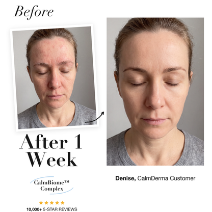 Before and after 1 week, forehead and eyebrow redness